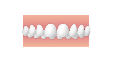 歯並び_過蓋咬合 |大和市の歯医者・矯正歯科 大和東さくら歯科・矯正歯科
