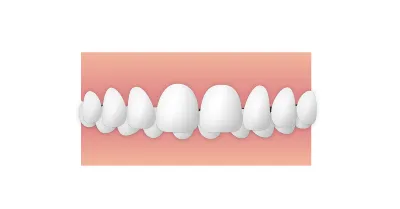 歯並び_過蓋咬合 |大和市の歯医者・矯正歯科 大和東さくら歯科・矯正歯科
