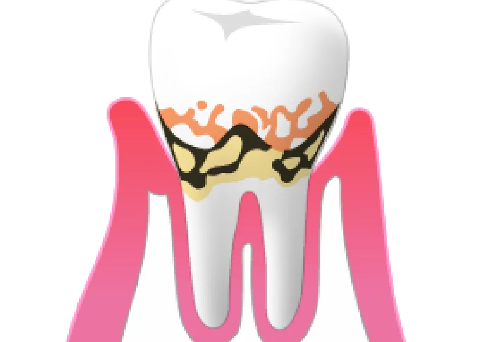 軽度の歯周炎|大和市大和駅徒歩4分の歯医者 大和東さくら歯科・矯正歯科