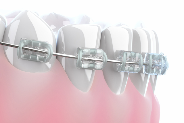 ワイヤー矯正|大和市の歯医者・矯正歯科 大和東さくら歯科・矯正歯科