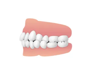 交叉咬合　大和市大和の歯医者 大和東さくら歯科矯正歯科