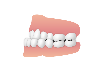 歯並び_受け口|大和市の歯医者・矯正歯科 大和東さくら歯科・矯正歯科