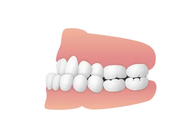 歯並び_受け口|大和市の歯医者・矯正歯科 大和東さくら歯科・矯正歯科