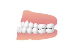 受け口　イラスト