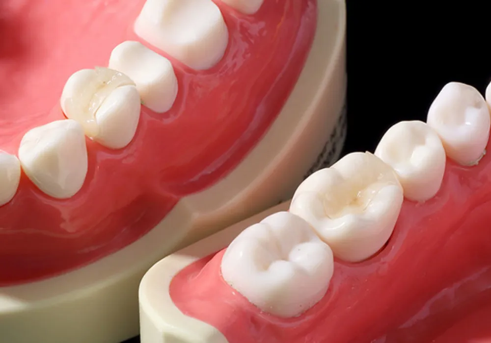 セラミックインレー,アンレー|大和市大和駅徒歩4分の歯医者 大和東さくら歯科・矯正歯科