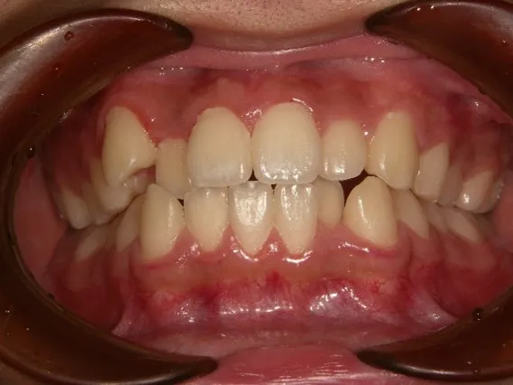 矯正歯科 Before|大和の矯正歯科 大和東さくら歯科・矯正歯科