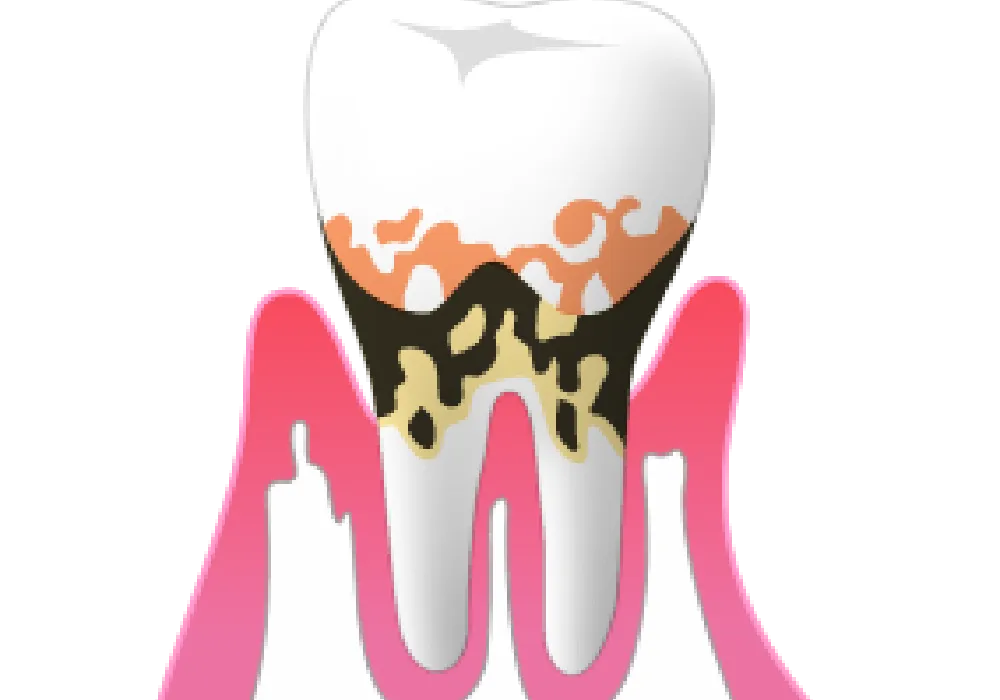 中度の歯周炎|大和市大和駅徒歩4分の歯医者 大和東さくら歯科・矯正歯科