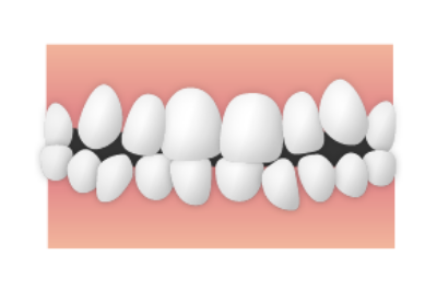 乱杭歯（らんぐいし）／叢生（そうせい）|大和市の歯医者・矯正歯科 大和東さくら歯科・矯正歯科