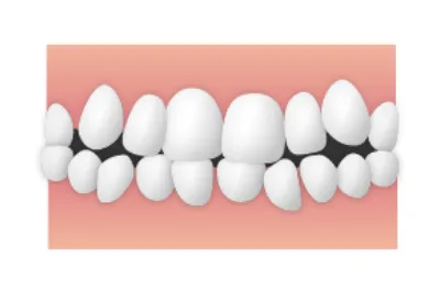 乱杭歯(らんぐいし)/叢生(そうせい)|大和市の歯医者・矯正歯科 大和東さくら歯科・矯正歯科