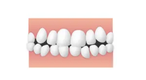 叢生 大和市大和の歯医者 大和東さくら歯科・矯正歯科
