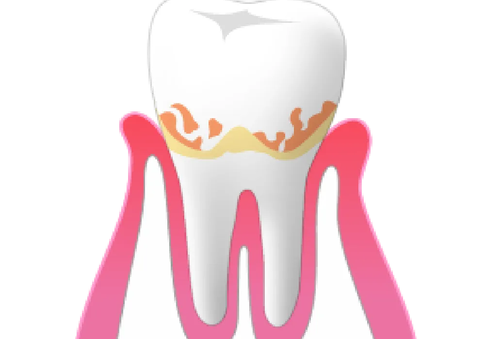 初期(歯肉炎)|大和市大和駅徒歩4分の歯医者 大和東さくら歯科・矯正歯科