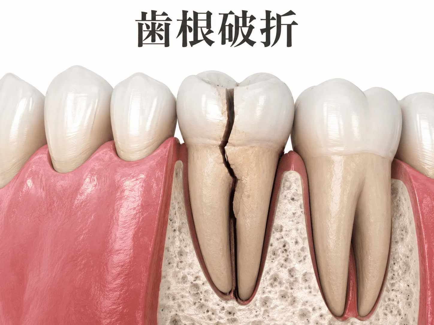 歯根破折