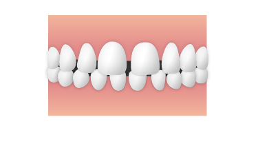 歯並び_すきっ歯|大和市の歯医者・矯正歯科 大和東さくら歯科・矯正歯科