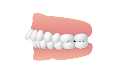 歯並び_出っ歯（上顎前突・下顎遠心咬合）|大和市の歯医者・矯正歯科 大和東さくら歯科・矯正歯科