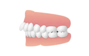 出っ歯　大和市大和の歯医者 大和東さくら歯科・矯正歯科