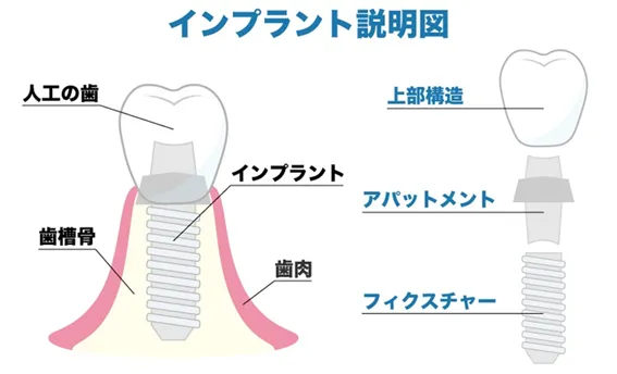 インプラント説明図